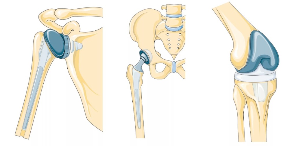несколько типов эндопротезирования